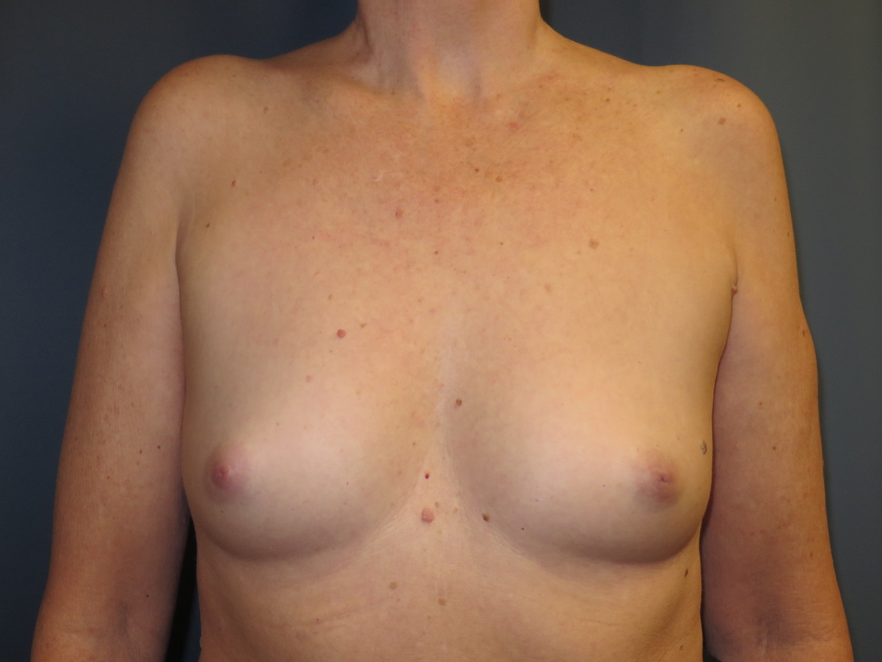 before photo of breast augmentation patient - front view before photo of breast augmentation patient - front view