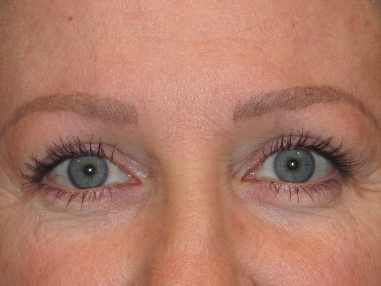 before photo of upper eyelid surgery patient - front view before photo of upper eyelid surgery patient - front view