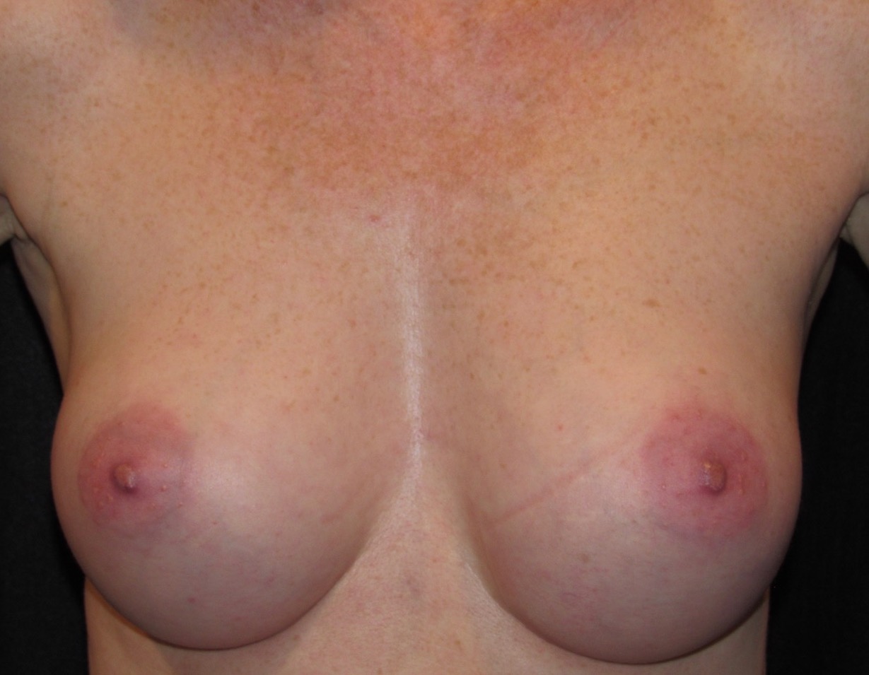 after photo of breast augmentation patient - front view after photo of breast augmentation patient - front view