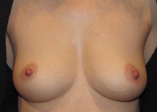 before photo of breast augmentation patient - front view before photo of breast augmentation patient - front view