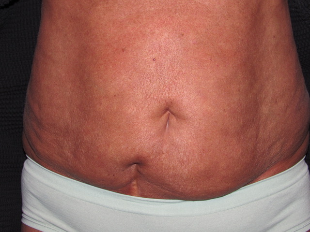 before photo of abdominoplasty patient - front view before photo of abdominoplasty patient - front view
