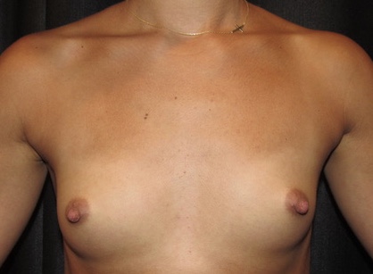 before photo of breast augmentation patient - front view before photo of breast augmentation patient - front view