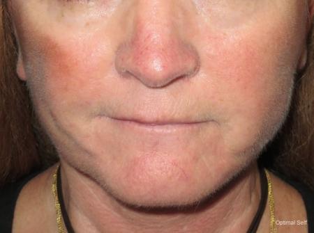 Facelift and Mini Facelift Before and After Pictures in Greenville, SC