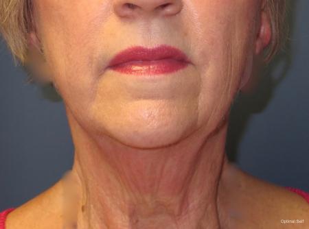 Neck Lift and Mini Neck Lift Before and After Pictures in Greenville, SC
