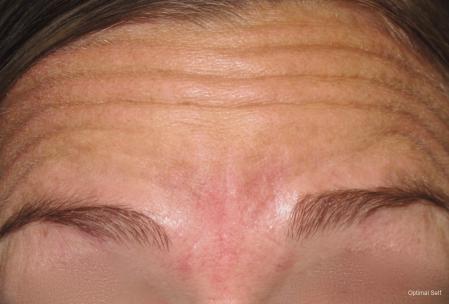 Botox® and Neurotoxins Before and After Pictures in Greenville, SC