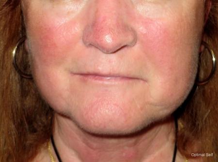 Facelift and Mini Facelift Before and After Pictures in Greenville, SC