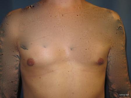 Gynecomastia Before and After Pictures in Greenville, SC