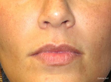 Juvederm® and Dermal Before and After Pictures in Greenville, SC