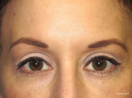 Blepharoplasty (Eyelid Surgery) Before and After Pictures in Greenville, SC