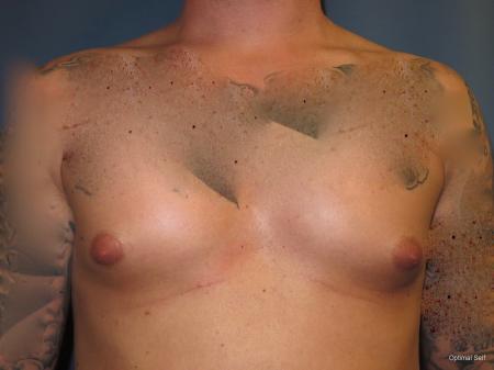 Gynecomastia Before and After Pictures in Greenville, SC