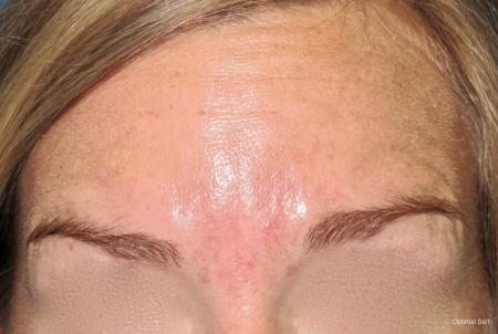 Botox® and Neurotoxins Before and After Pictures in Greenville, SC