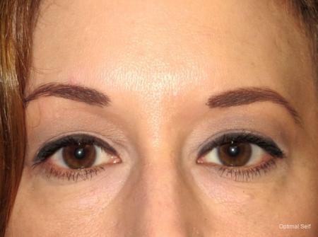 Blepharoplasty (Eyelid Surgery) Before and After Pictures in Greenville, SC