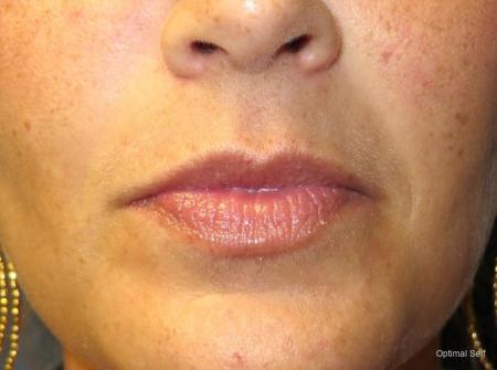 Juvederm® and Dermal Fillers Before and After Pictures in Greenville, SC