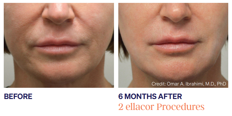 Ellacor-before-and-after